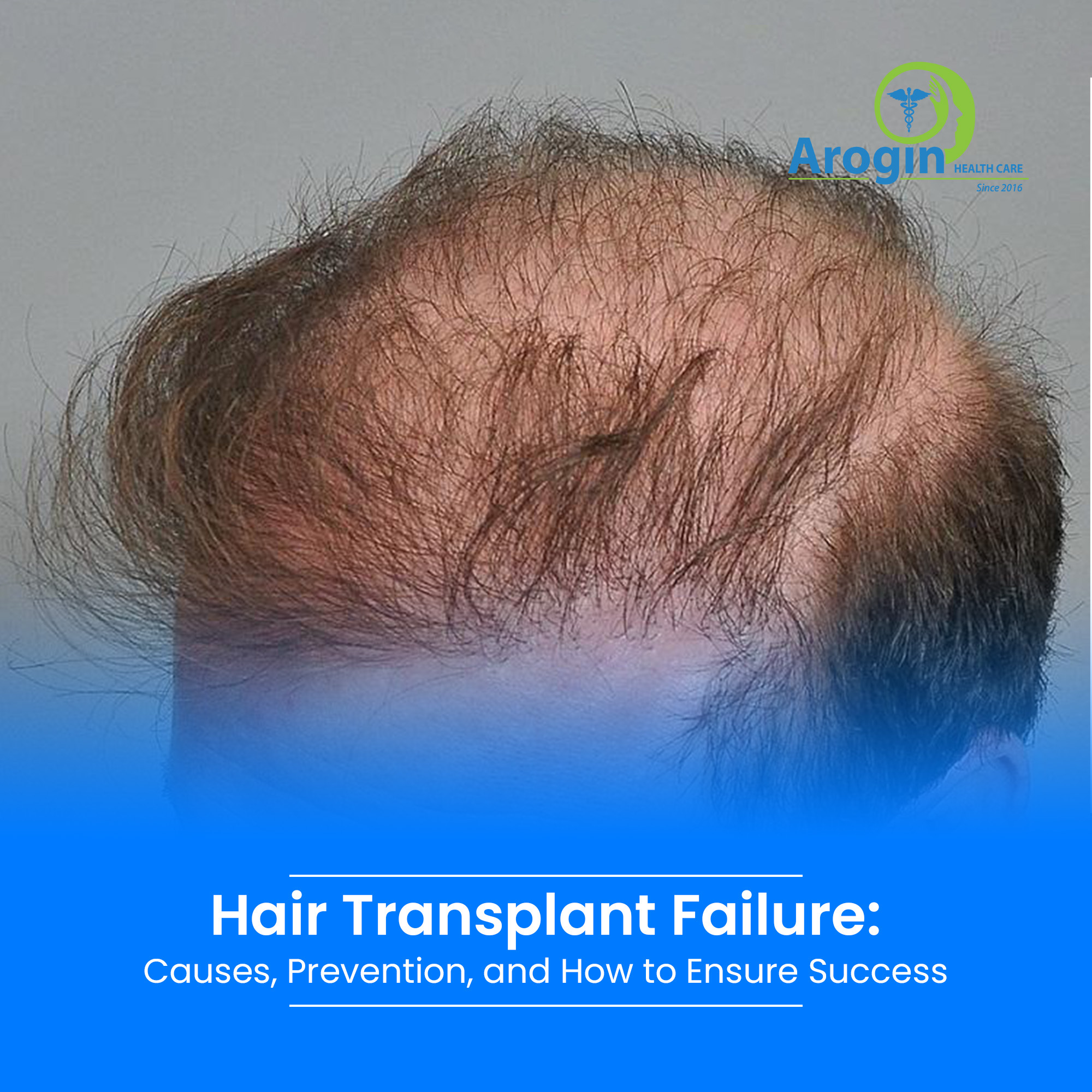 Hair Transplant Failure: Causes, Prevention, and How to Ensure Success